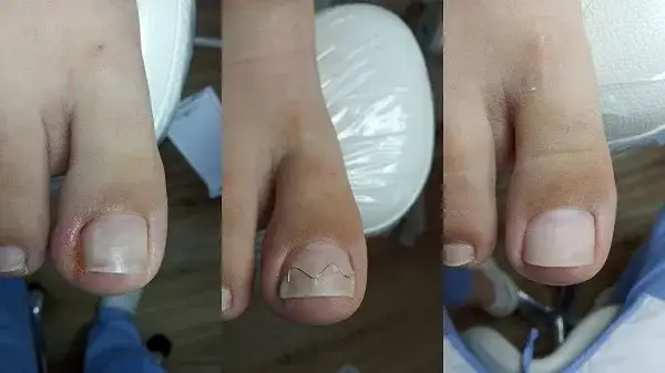 Klamra na paznokieć czy boli? Odkryj prawdę o bólu podczas zabiegu