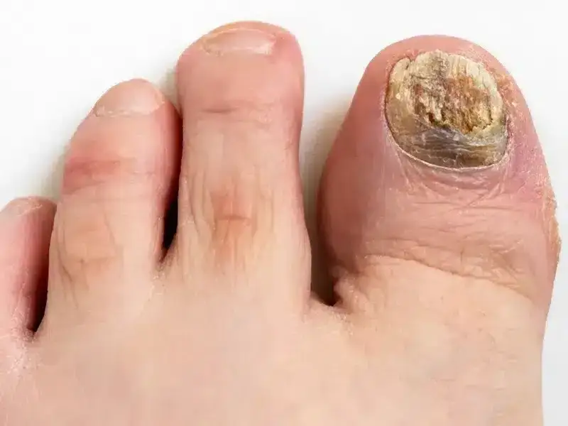 Jak skutecznie leczyć zrogowaciałe paznokcie u nóg i uniknąć bólu