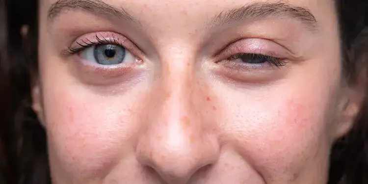 Opryszczka oka ile trwa? Poznaj czas trwania i skutki infekcji Opryszczka oka ile trwa? Poznaj czas trwania i skutki infekcji