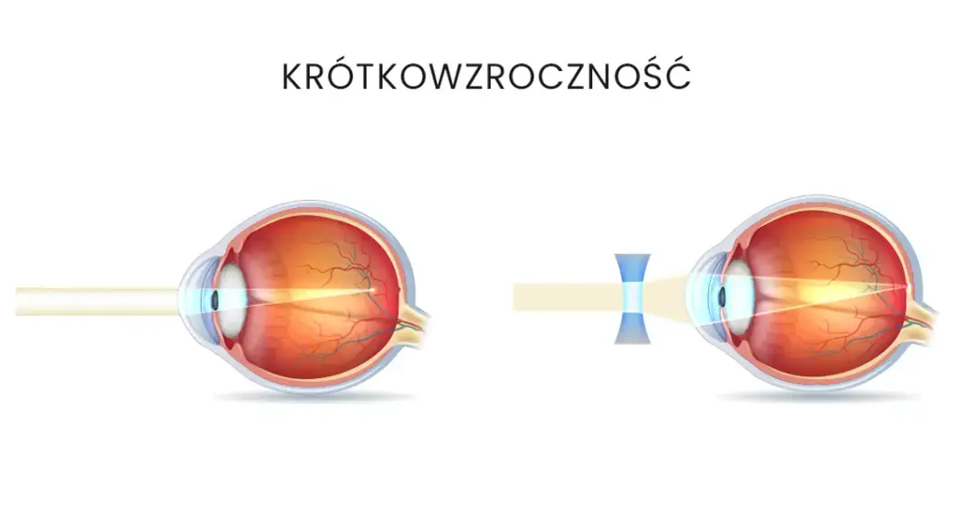 Czy krótkowzroczność można wyleczyć okularami? Prawda o korekcji wzroku