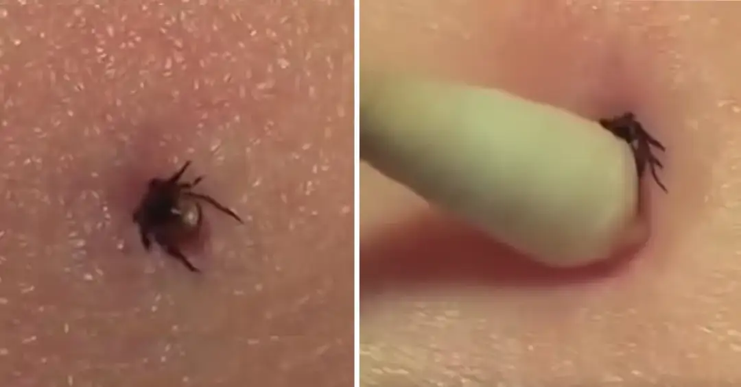 Jak usunąć kleszcza patyczkiem do uszu bez ryzyka infekcji