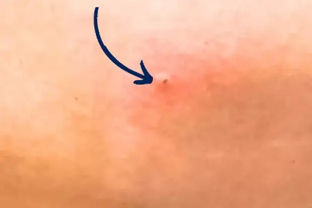 Jak wygląda ugryzienie kleszcza i co może oznaczać dla zdrowia