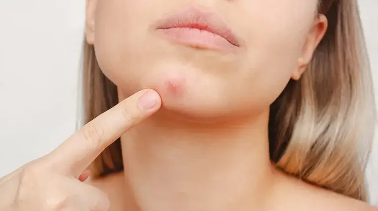 Jak pozbyć się pryszcza pod skórą? Skuteczne sposoby i porady