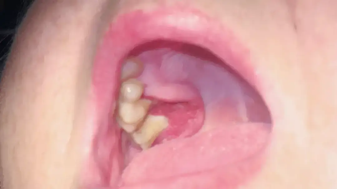 Jak wygląda rak jamy ustnej: Jak rozpoznać raka jamy ustnej na podstawie wyglądu?