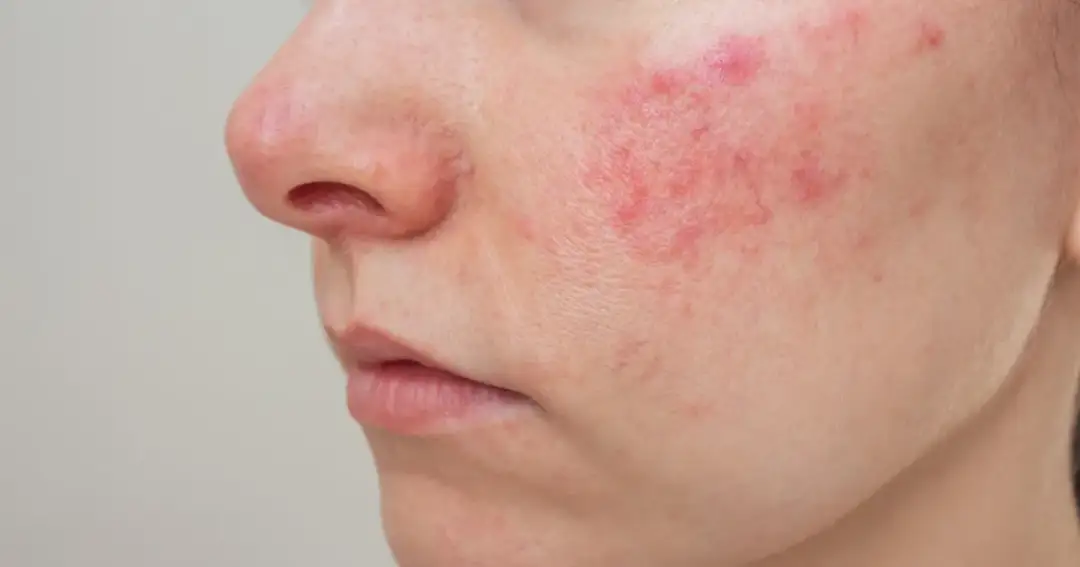 Pryszcze na twarzy znaczenie: co mówią o twoim zdrowiu?