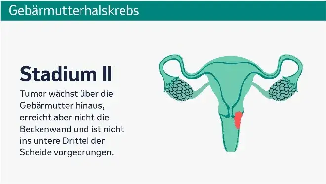 Wichtige Informationen zur Gebärmutterhalskrebs Vorsorge für Frauen