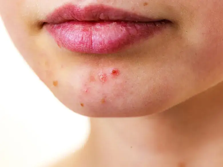 Dlaczego pryszcze wyskakują w tym samym miejscu? Oto najczęstsze przyczyny