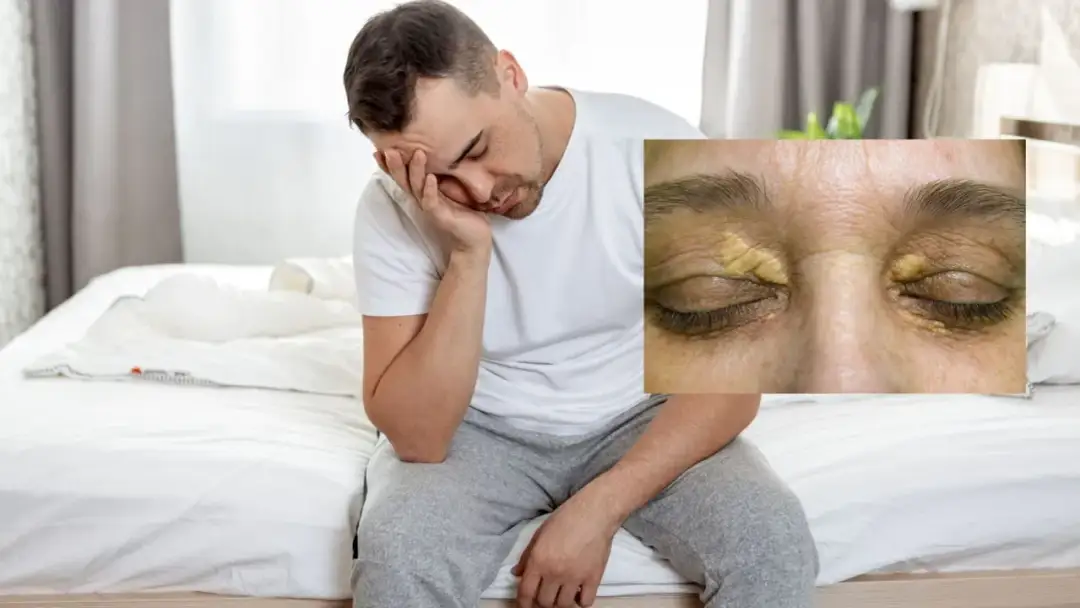 Podwyższony cholesterol objawy: jak je rozpoznać i co robić?