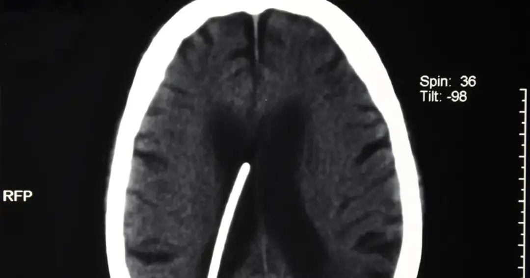 Wodogłowie u dorosłych objawy – jak je rozpoznać i uniknąć powikłań