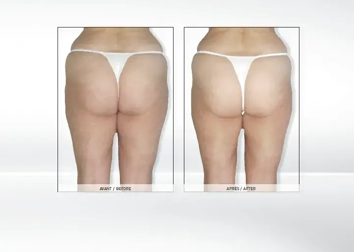 Endermologia: Kiedy efekty i jak utrzymać je na dłużej?