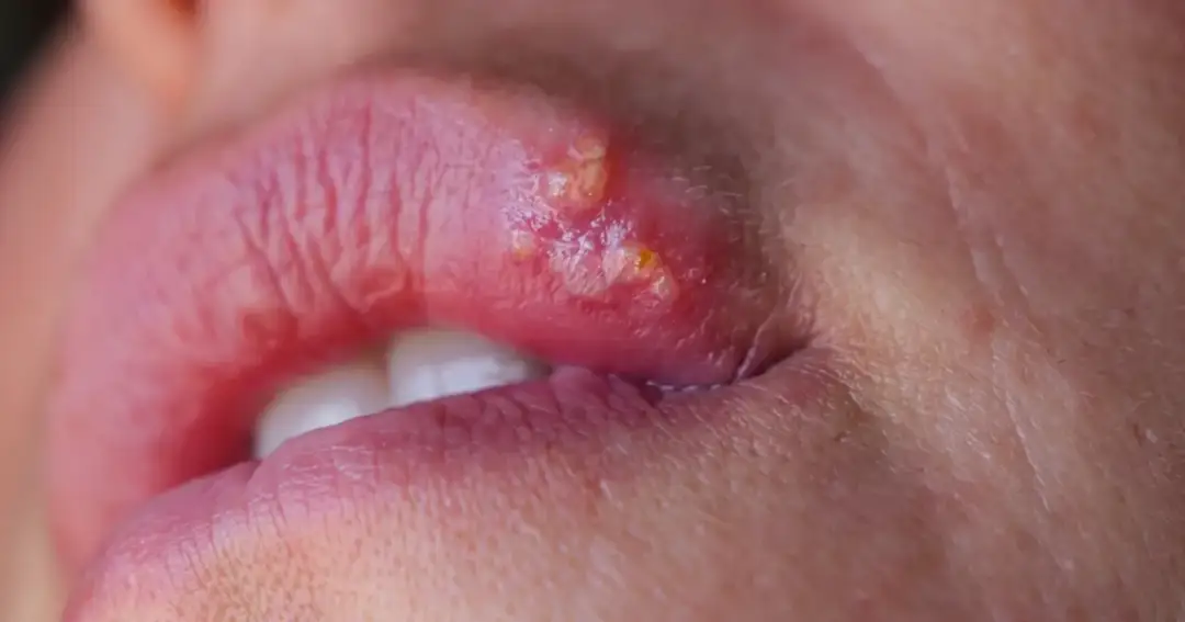 Opryszczka czy pryszcz: jak je odróżnić i uniknąć pomyłek