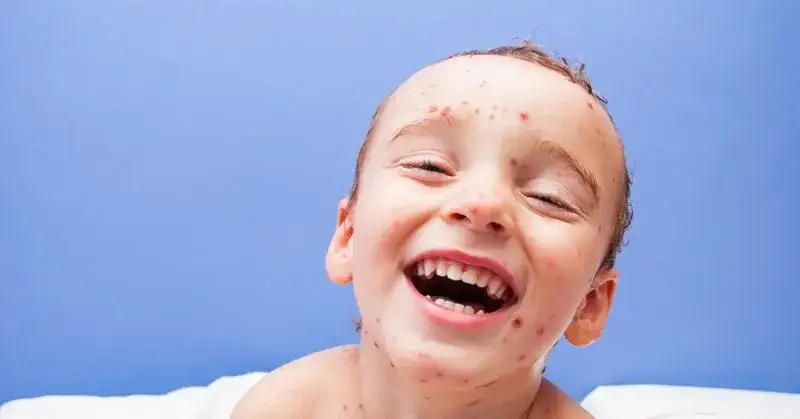 Jak zarazić się ospą: Jak chronić się przed zarażeniem ospą?