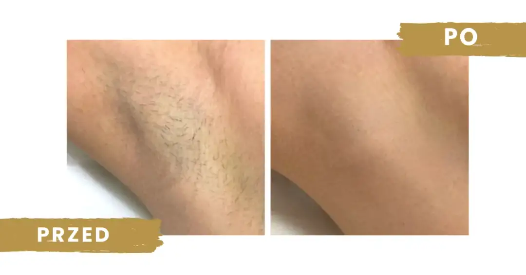 Depilacja laserowa co 2 tygodnie? Dlaczego to błąd i co robić?