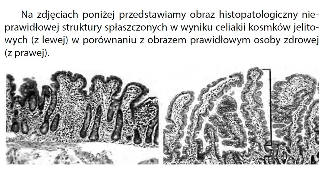 Celiakia - charakterystyczne objawy choroby trzewnej