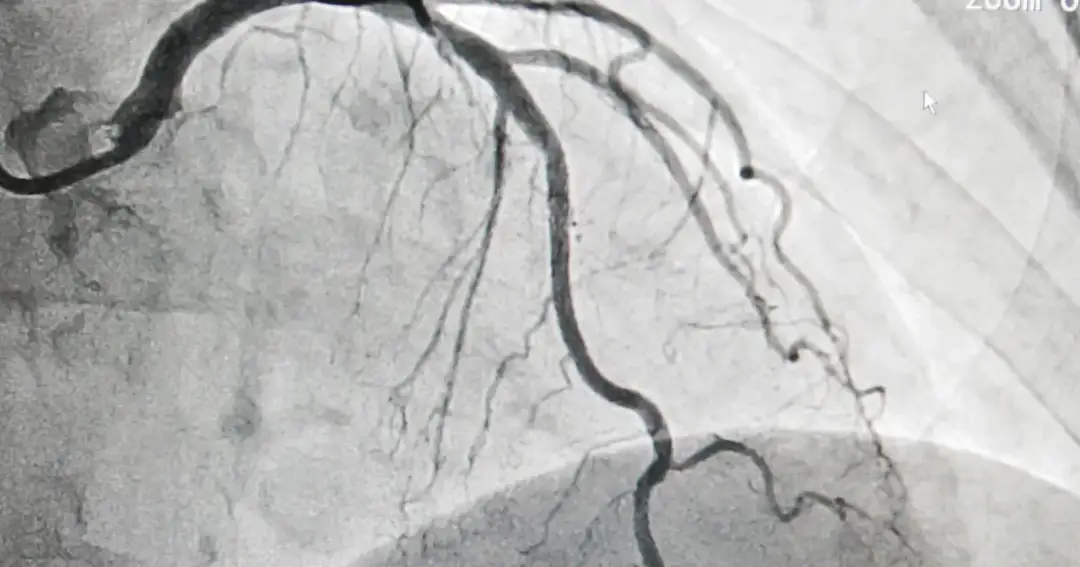 Koronografia - co to za badanie i jak może uratować Twoje serce Koronografia - co to za badanie i jak może uratować Twoje serce