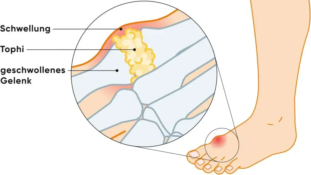 Gicht Symptome Fuß: So erkennen Sie die schmerzhaften Anzeichen