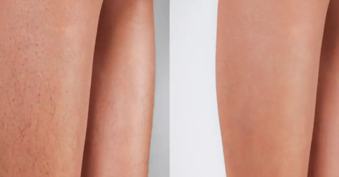 Depilacja laserowa: Przygotowanie krok po kroku. Bezpieczeństwo i efekt!