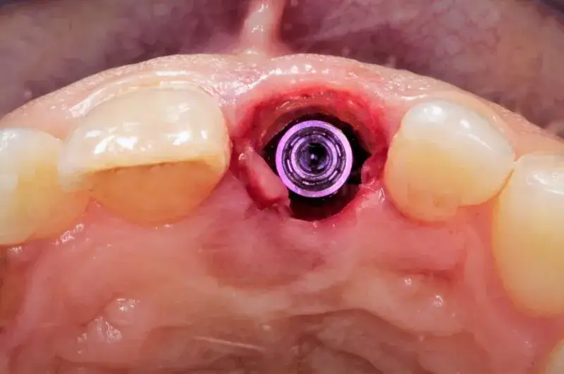 Implant zęba: cały proces leczenia krok po kroku