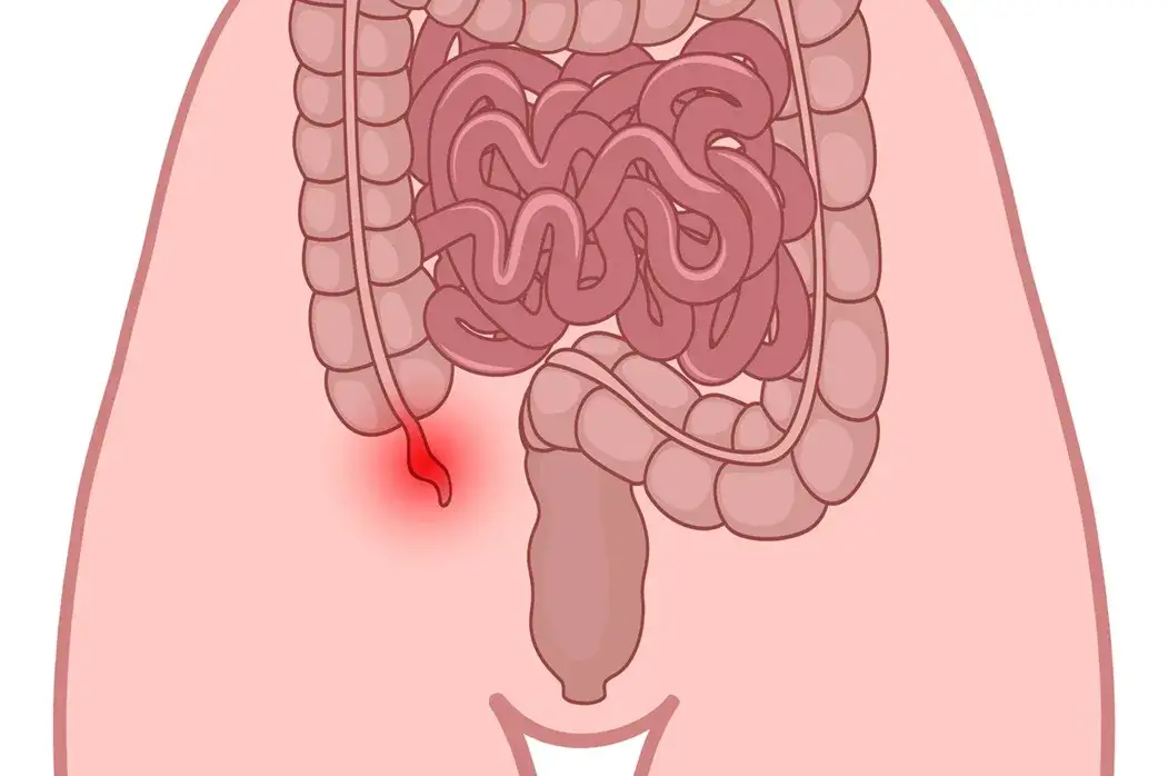 Objawy zapalenia wyrostka robaczkowego u dziecka – nie ignoruj tych sygnałów