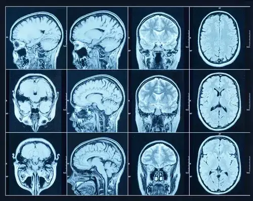 Czy rezonans wykryje choroby psychiczne? Prawda o MRI głowy