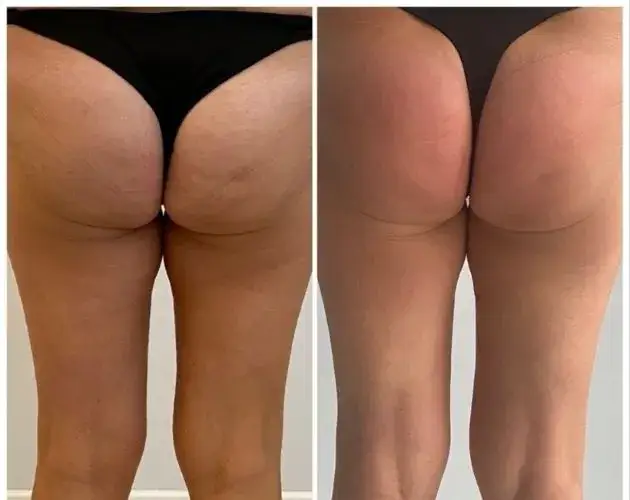 Idealne tyłki - jak osiągnąć atrakcyjne pośladki naturalnie