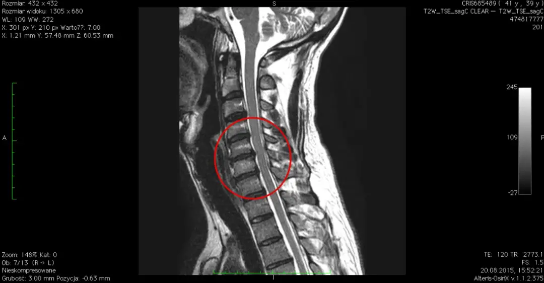 Choroba krążka szyjnego z uszkodzeniem nerwów: objawy i leczenie