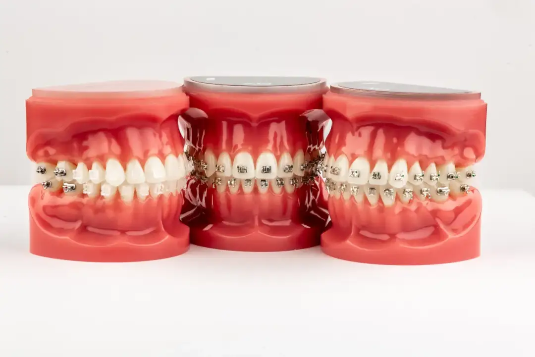 Jak wygląda stały aparat na zęby? Odkryj jego różne typy i wygląd