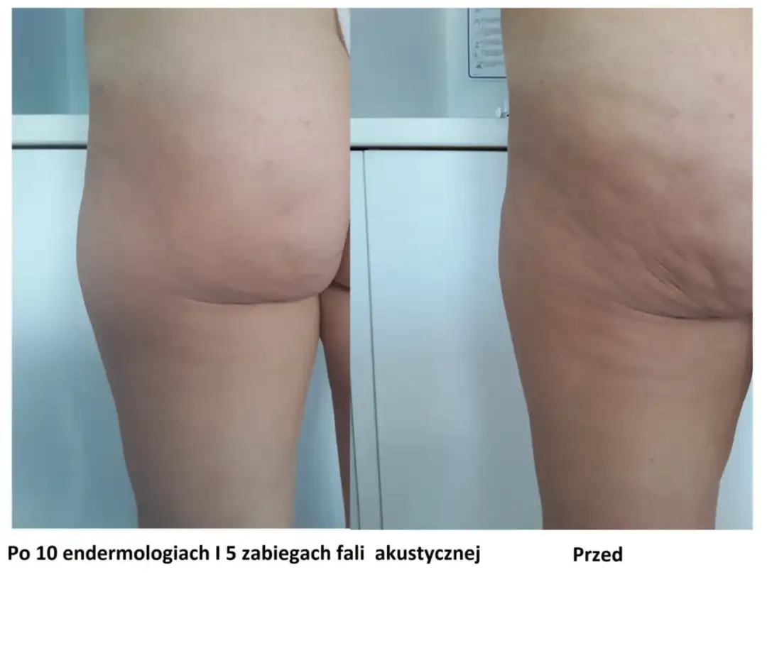 Skuteczne metody na cellulit - jak leczyć cellulit w domu i w gabinecie