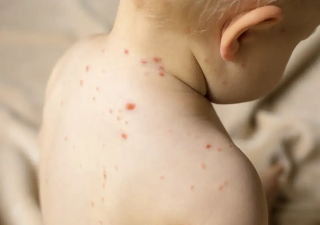 Covid wysypka u dzieci: Jak rozpoznać i leczyć wysypkę?