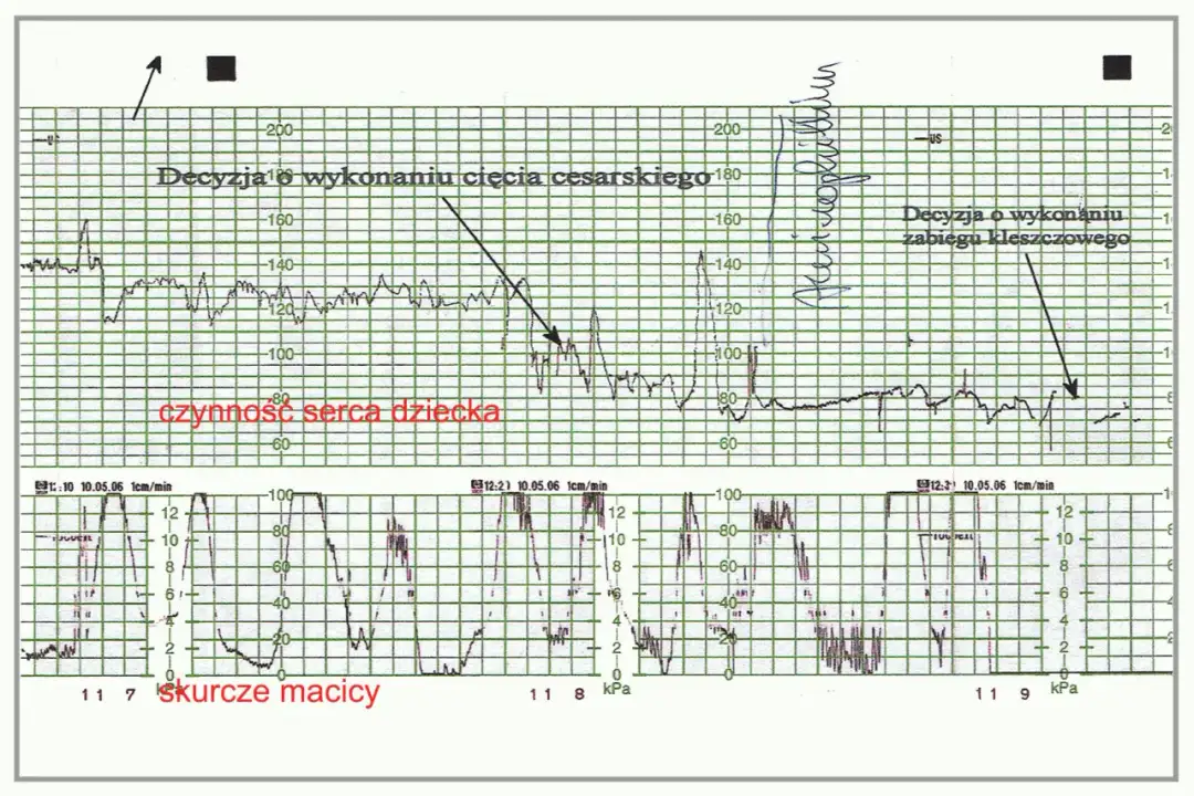 Jak czytać zapis KTG na monitorze i zrozumieć zdrowie płodu