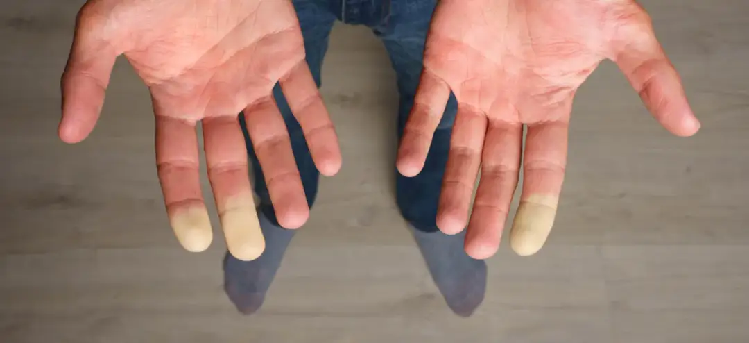 Tarczyca a objaw Raynauda - co musisz wiedzieć o powiązaniach?