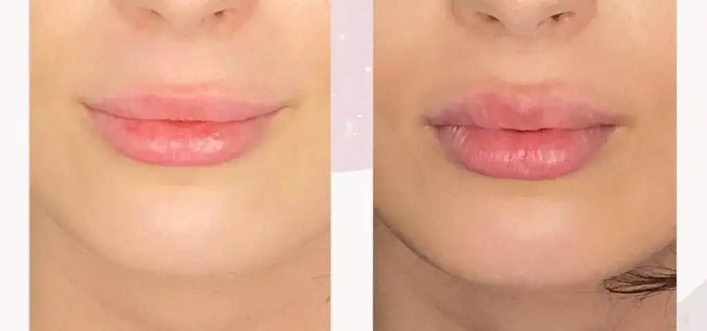 Kiedy efekt po kwasie hialuronowym? Poznaj czas widocznych rezultatów