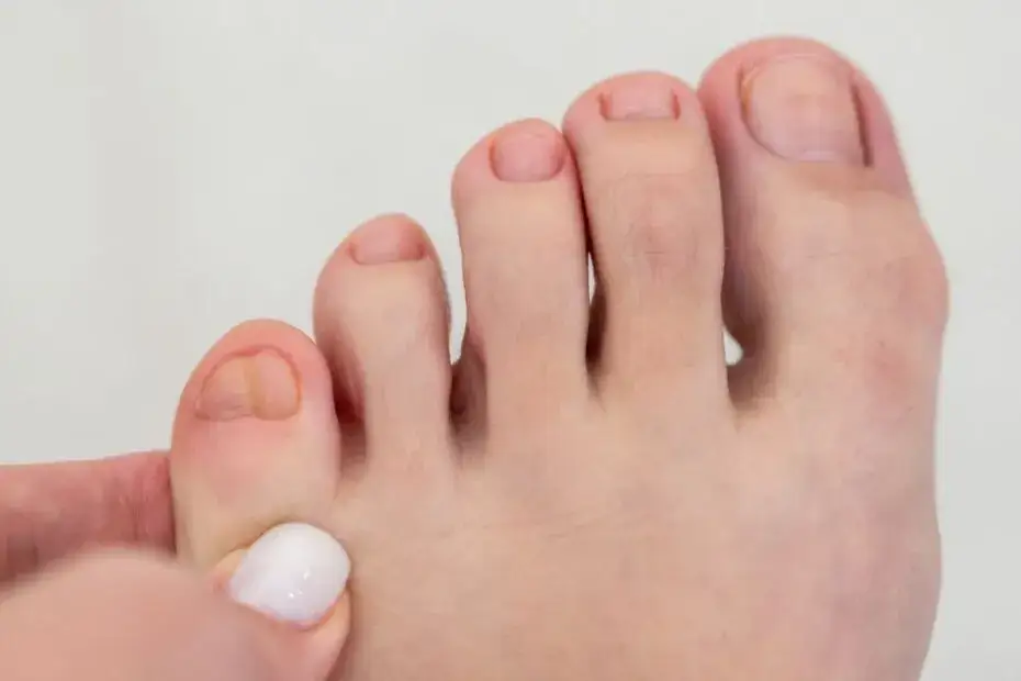 Skuteczne sposoby moczenia stopy z odciskiem, które przynoszą ulgę