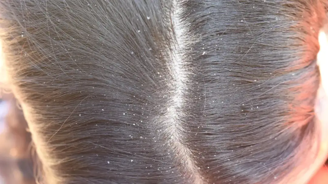 Masz łupież? Jak zwalczyć go domowymi sposobami - Naturalne metody