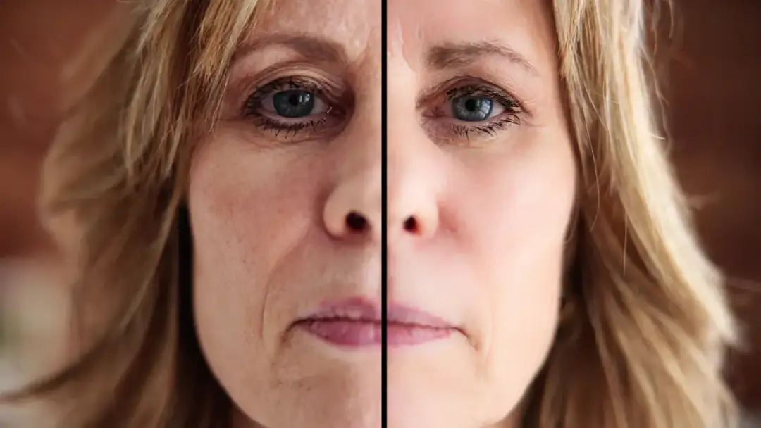 Jak podnieść brwi botoksem i uzyskać naturalny efekt bez bólu