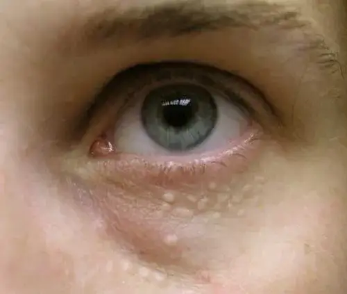 Jak usunąć gruczolak potowy pod oczami? Unikaj operacji!