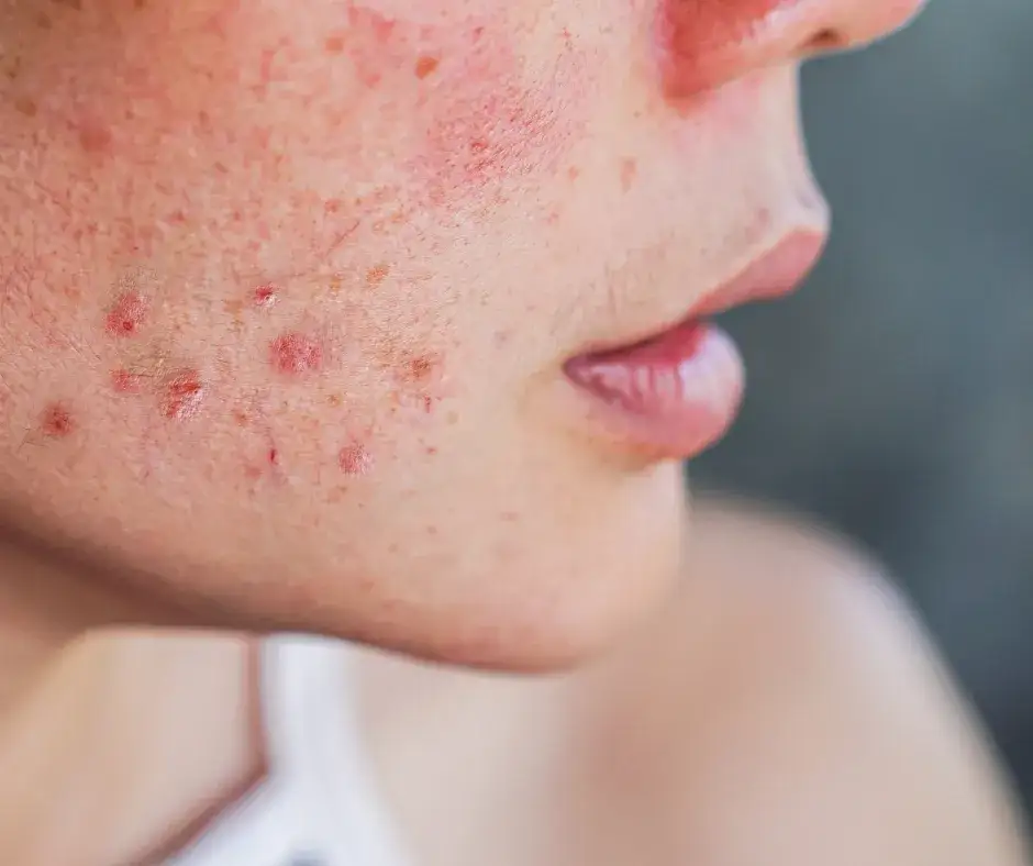 Pryszcze: Od czego wychodzą? Zrozum skórę i pozbądź się problemu