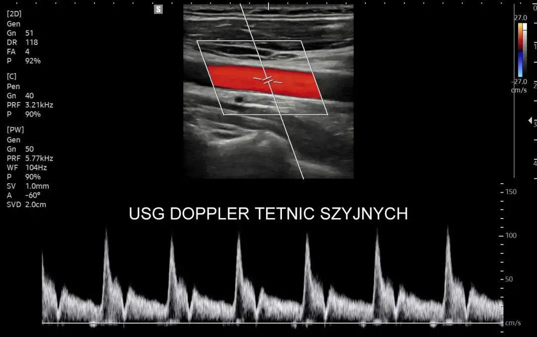 USG Doppler tętnic szyjnych - Profilaktyka udaru i co oznaczają wyniki