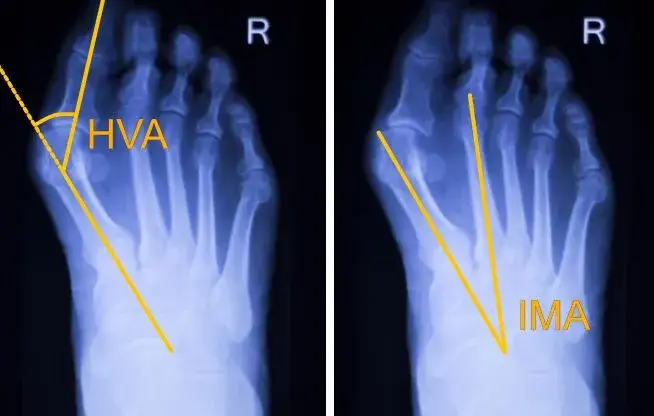 Haluks: Operacja krok po kroku. Co musisz wiedzieć przed zabiegiem?