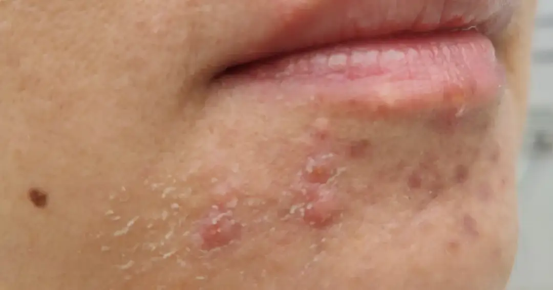 Pryszcze na brodzie: Skuteczne sposoby, przyczyny i leczenie