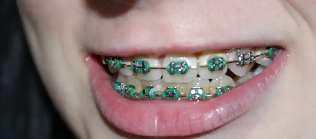 Jak działa aparat na zęby? Odkryj tajemnice skutecznego leczenia