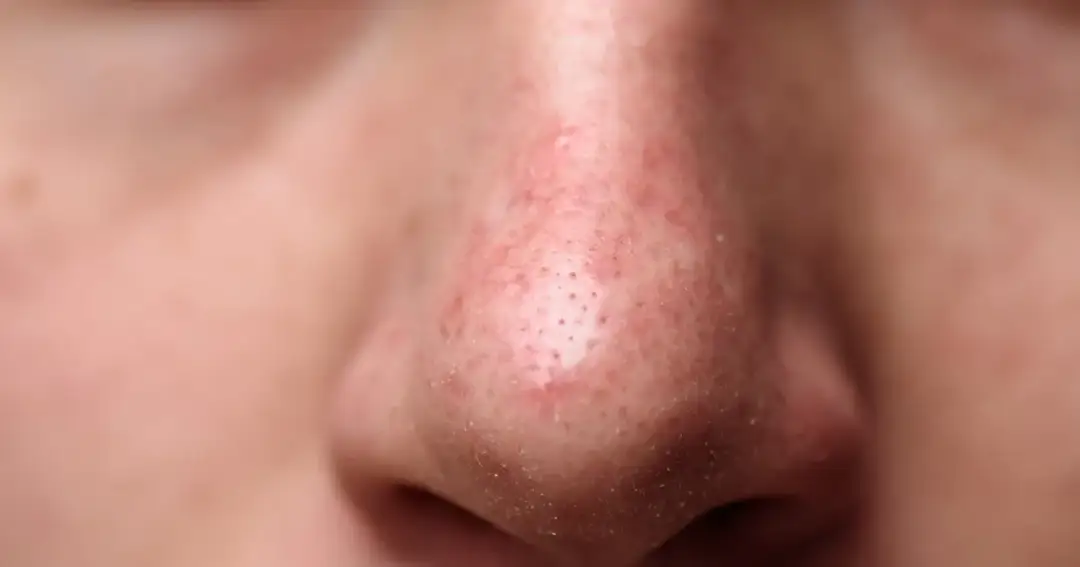 Pryszcze na nosie: Dlaczego powstają i jak się ich skutecznie pozbyć?