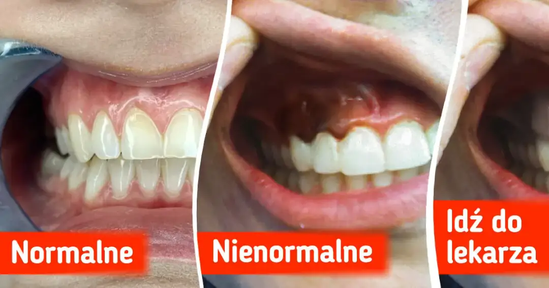 Jak wyglądają zdrowe dziąsła? Poznaj cechy i unikaj problemów z nimi