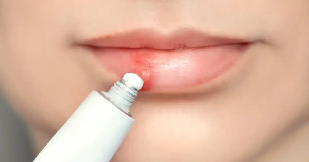 Opryszczka na ustach po makijażu permanentnym – jak skutecznie leczyć?
