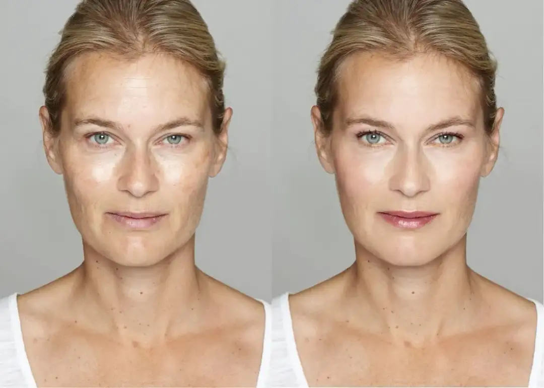 Ile kosztuje botox na czoło? Ceny w Polsce i co warto wiedzieć