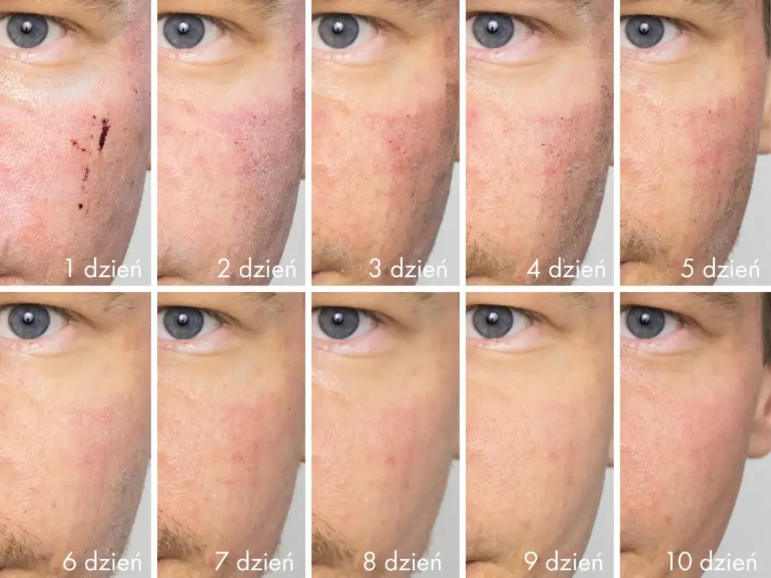 Laser frakcyjny na co pomaga - skuteczne rozwiązania dla Twojej skóry