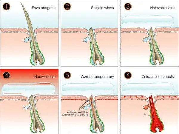 Epilacja – co to jest i jak różni się od depilacji? Dowiedz się!