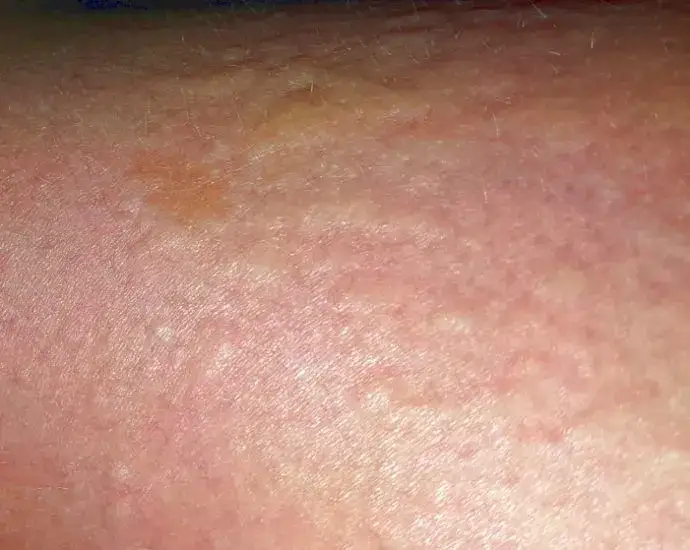 Gluten intoleranz symptome: Erkennen Sie die versteckten Anzeichen