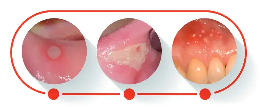 Afta na dziąśle: ile trwa gojenie? Skuteczne leczenie i ulga