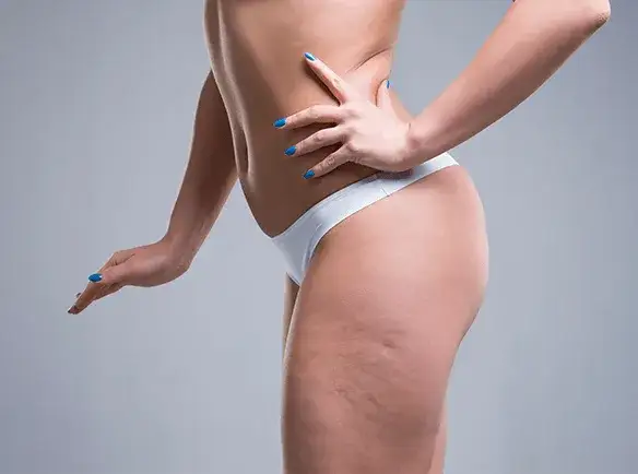 Dlaczego powstaje cellulit? Poznaj przyczyny i jak ich uniknąć Dlaczego powstaje cellulit? Poznaj przyczyny i jak ich uniknąć